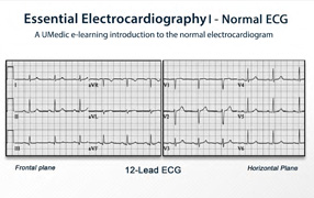 Normal ECG PDF