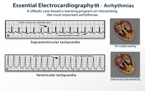 Arrhythmias PDF